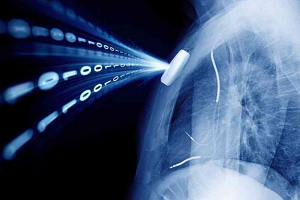 Collecte de données des patients liées à l’implant d’un dispositif médical